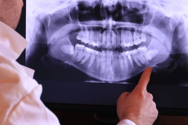 Best Emergency Wisdom Tooth Extraction in Chisholm, ME